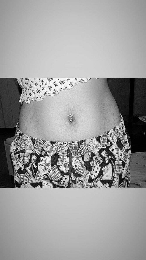 ขอวิธีลดหน้าท้องแตกลายหน่อยจ้าแม่ๆ.