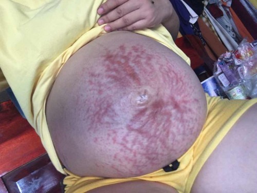 มีแม่บ้านไหนท้องแตกลายแบบนี้ไหมคะอันตรายกับลูกน้อยรึเปล่า