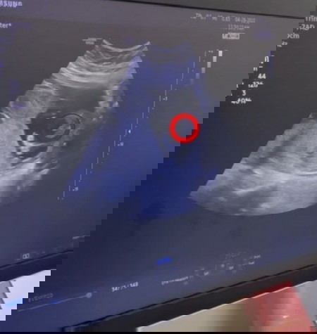 Twin #1 Ultrasound