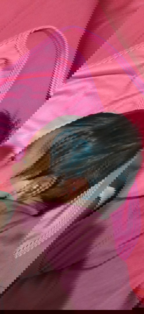 Bayi cephal hematoma sehari setelah lahiran