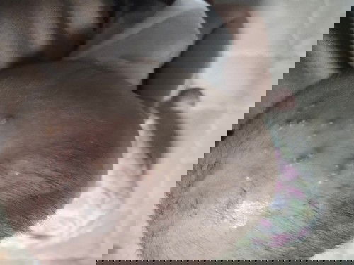 ตุ่มหนองที่หัว