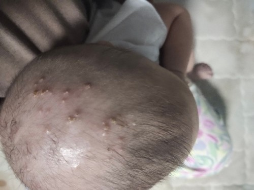 ตุ่มหนองที่หัว