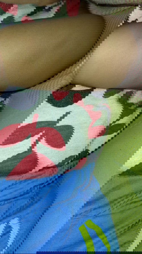 Mosquito bite black scars