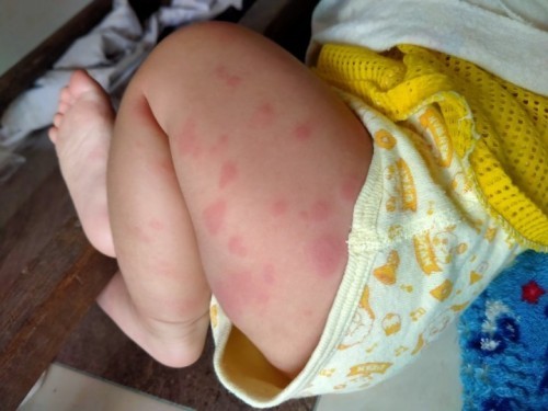 ลมพิษ ทำยังไงดี