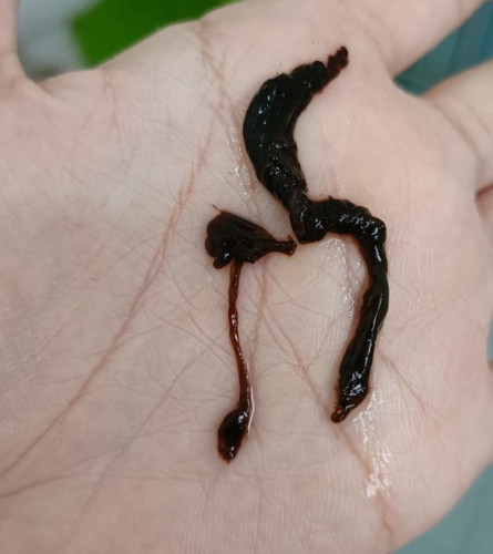 Blood clots while bathing