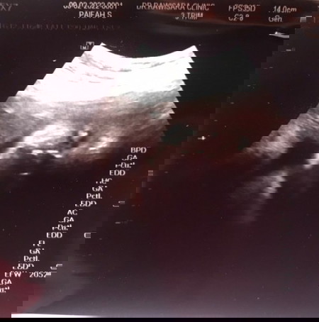 จะเป็นอันตรายมากไหมต่อลูกในท้องมากไหม