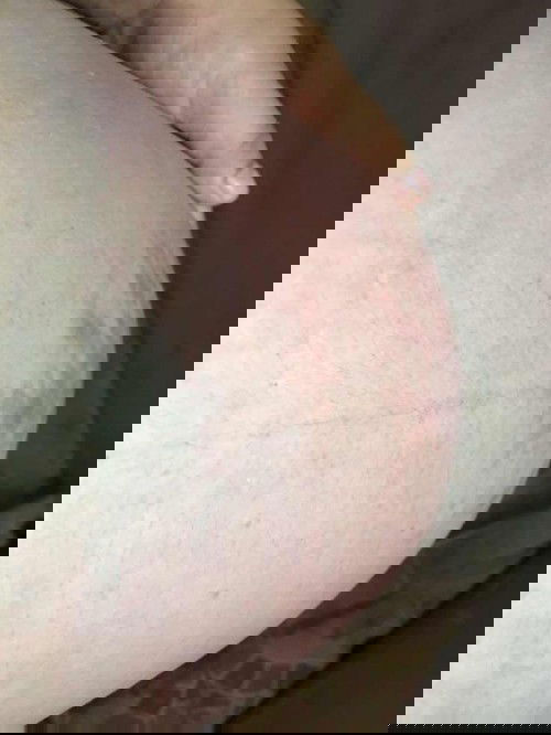 ผื่นคัน อันตรายกับน้องไหมคะ ขอคำแนะนำหน่อยค่ะ