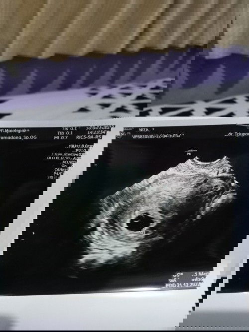 Menentukan perbedaan hitungan kehamilan menuturut HPHT / USG