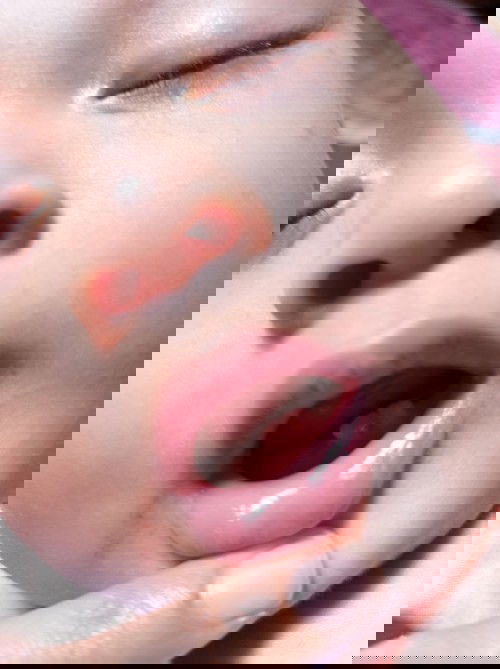 Ujung lidah terkena gigit