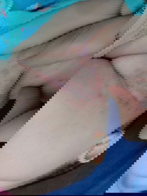 bé bị hăm
các m cho e hỏi, m nào có bé bị như vậy k, trời nắng nóng bé e bị hăm nổi hột nhìu như thế