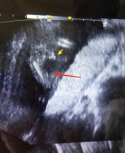 Girl or Boy?