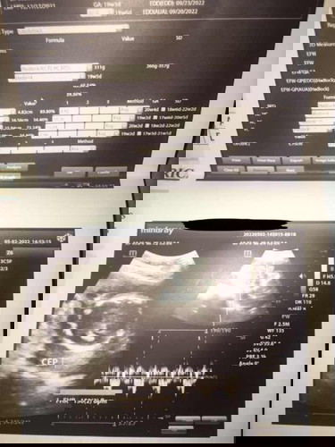 Ultrasound Gender
