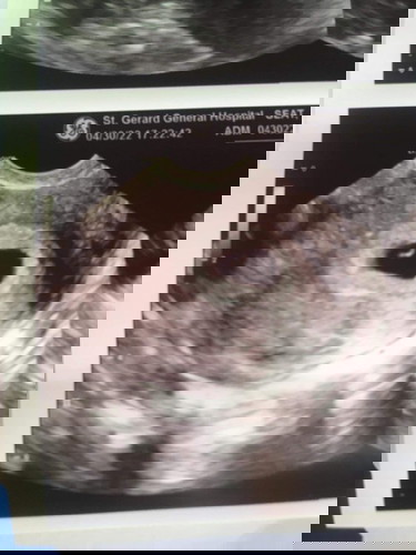 1st trimester.