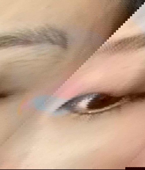 Mata Bengkak seperti bintitan