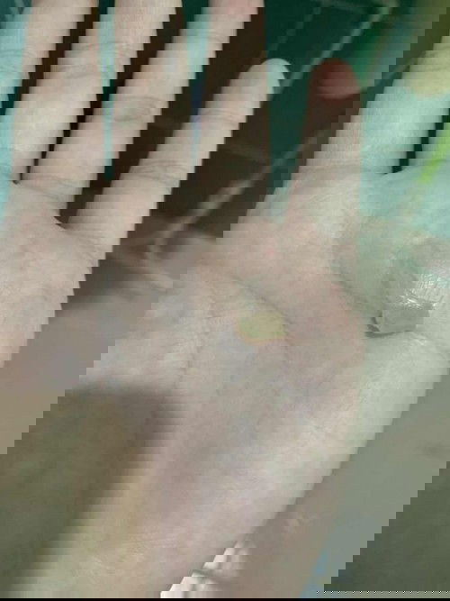 ตกขาวเป็นมูกเหนียว