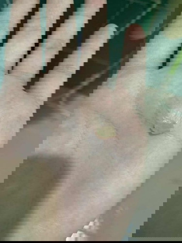 ตกขาวเป็นมูกเหนียว