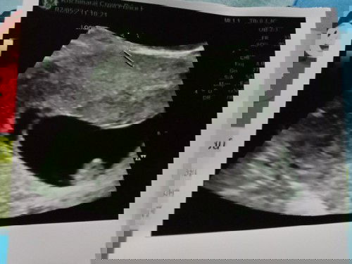 มาคู่คะแต่รอดแค่คนเดียว
คุณหมอบอกว่าแฝดแต่ลุดไปคนหนึ่ง
#เสียดายมากแม่