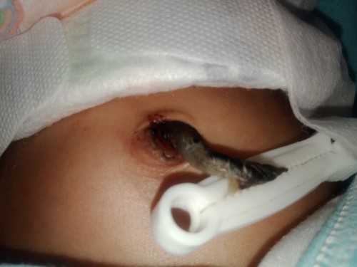 Mga mommy tanong lang Po Ang pusod kc Ng baby ko medyo my kaonting dugo