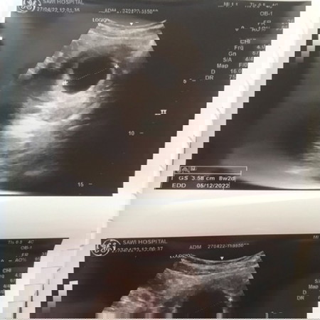 จากที่ซาวไม่เจอน้องหมอนัดอีกที่เมื่อวาน ผลออกมีแล้ว