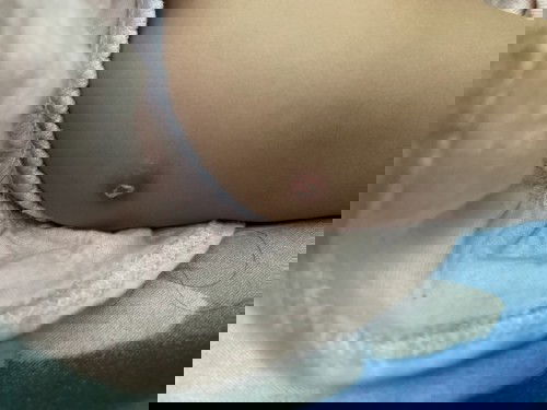 Bisul bchmg masih ada usia 7 bln