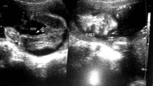 Pregnancy