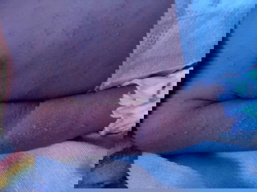 Kata dokter alergi susu sapi dll..