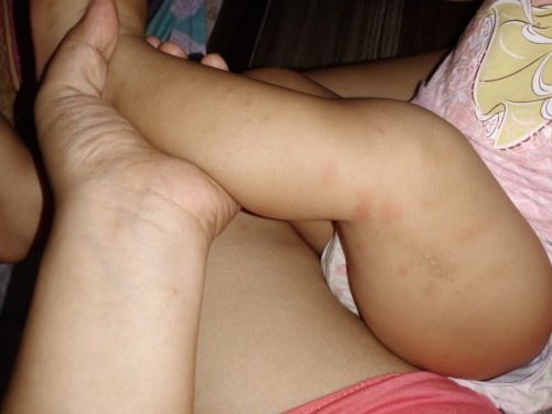 Ask ko lang po. Ano po kayang magandang cream para sa dito. Thank you in advance