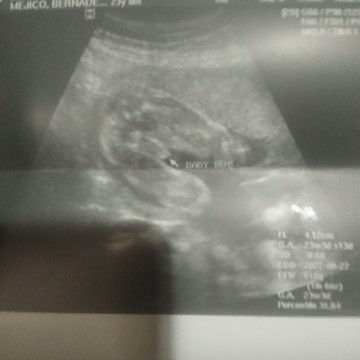 23 weeks and 4 daya naka cephalic position na ang baby ko.
Noramal ba tun??