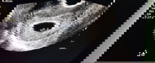 ท้องสอง8W พบภาวะแท้งคุกคามแม่มีตกขาวสีน้ำตาลออกกระปริบกระปอย แบบนี้น้องจะปลอดภัยไหม