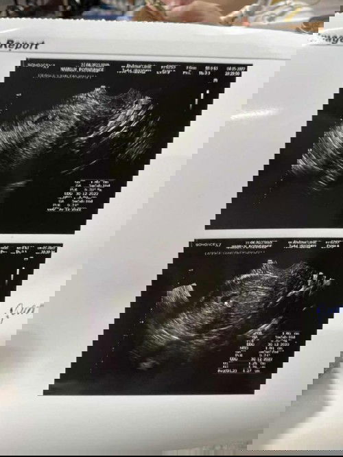 7 week ยังไม่เจอน้องเลย 😔