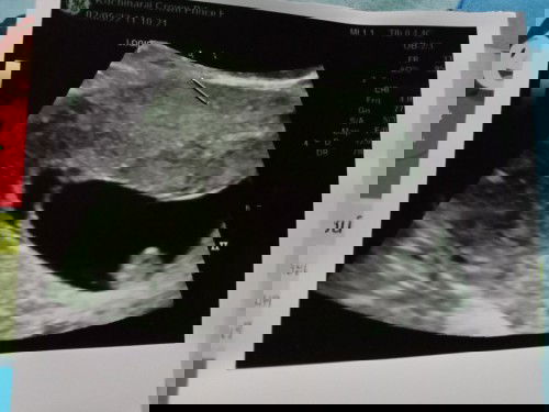 หมอบอกแฝดคะแต่รอดมาคนเดียว