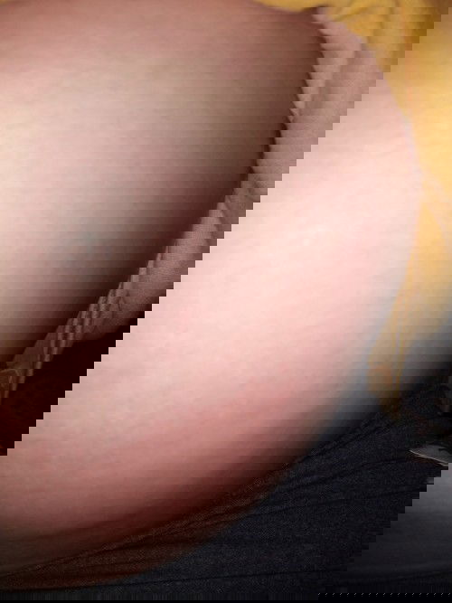 ตอนนี้ อายุครรภ์ 32 week แล้วค่ะ อยากทราบว่า อาการคันทั้งตัว ท้องก็คัน มีคุณแม่ท่านไหนเคยเป็นบ้างคะ