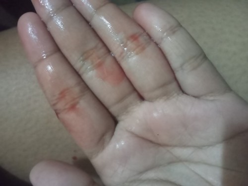 มีน้ำใสๆไหลออกจากช่องคลอด