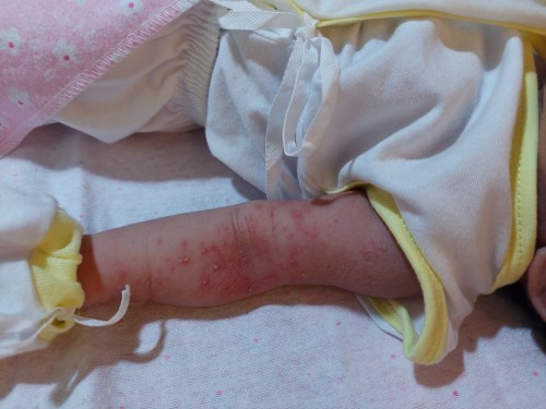 Rashes (10 days old baby)