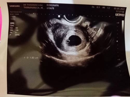 ประมาณกี่สัปดาห์ถึงจะพบตัวอ่อนคะ