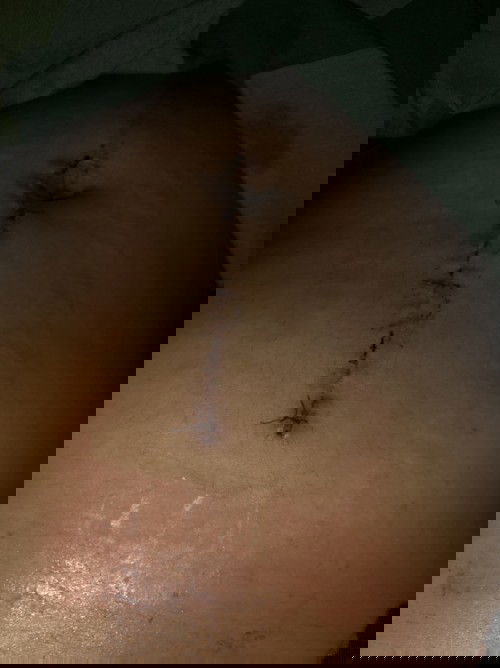 Operasi empedu saat hamil