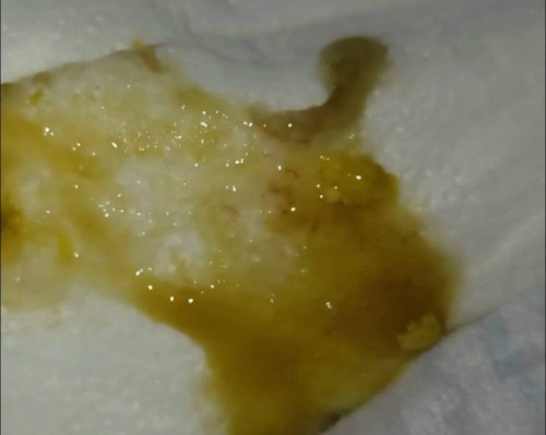 Normal poop or Not?