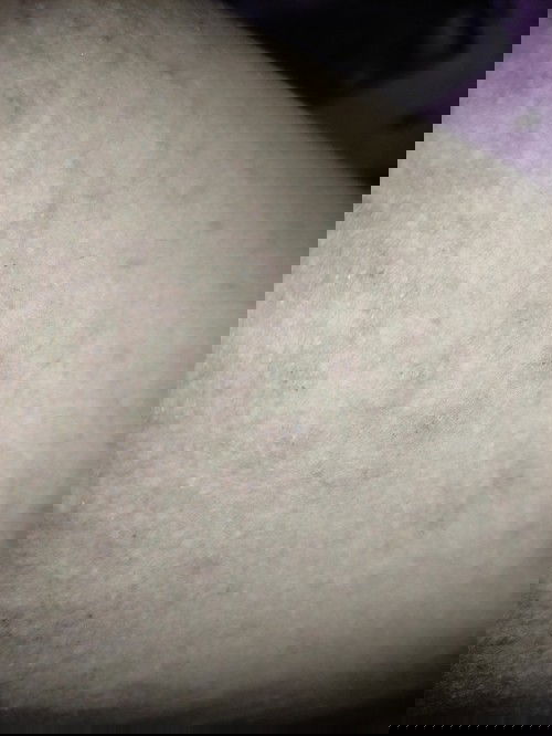 Gatal gatal hamil tm 3