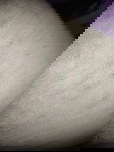 Gatal gatal hamil tm 3