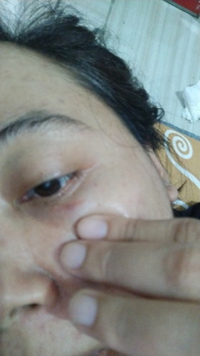 Ketularan dr ponakan,entah apa ini