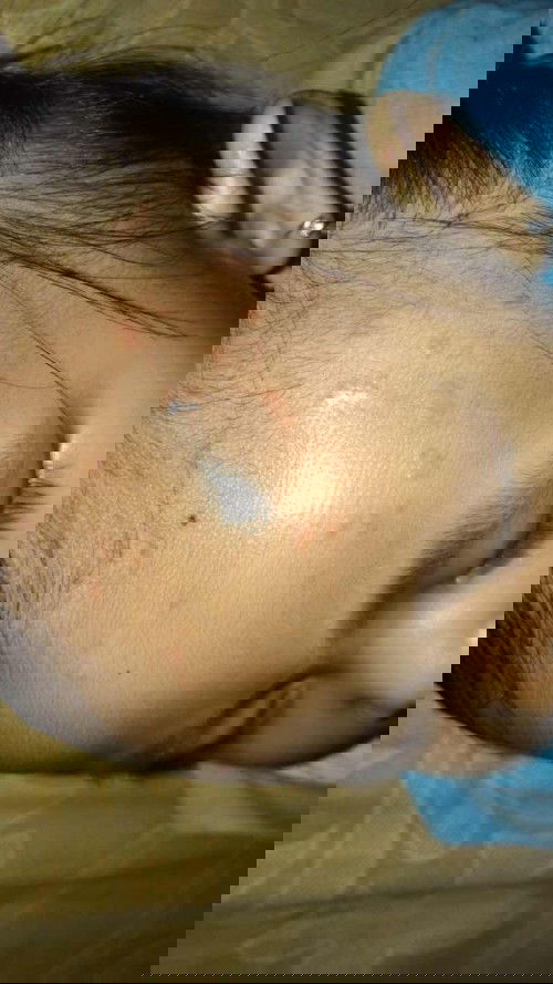 Bruntusan biasa atau apa ya bun ?