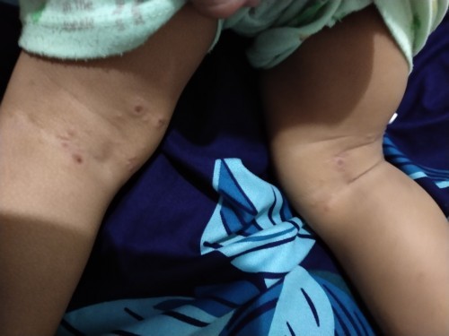 Badan tiba" bentol" dan semakin banyak