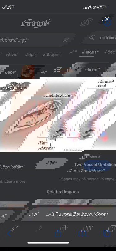 Detail scan 20weeks Dr ckp baby single umbilical artery. Ada yang having problem sma dgn sy ke?