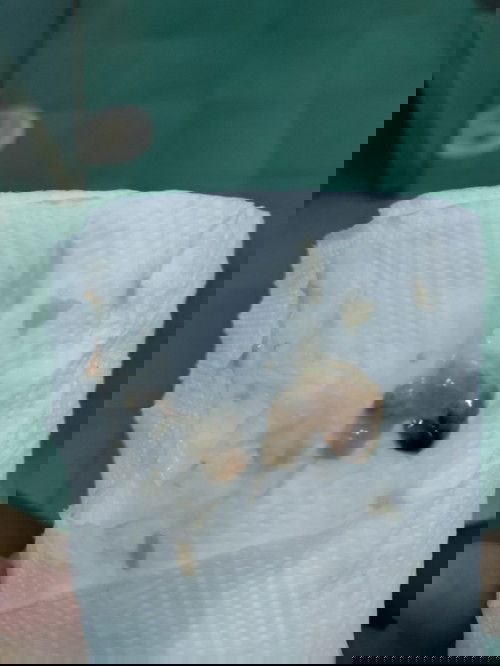 มีมูกเลือด