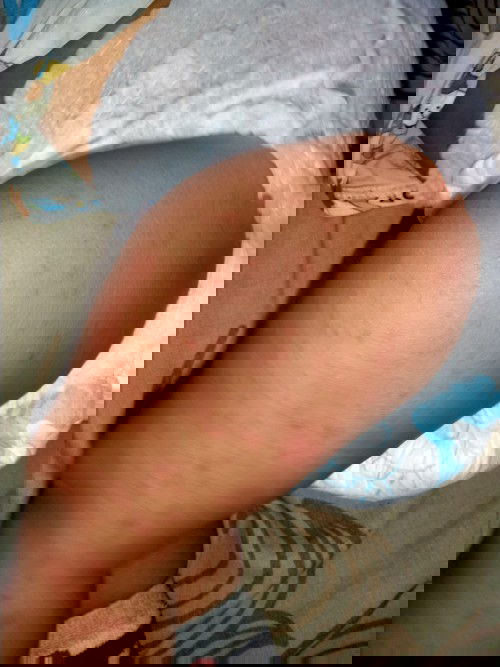 Pengobatan gatala gatal yg seperti di gambar ini apa ya Bun kita kira, saya sudah pakai lactasydbaby