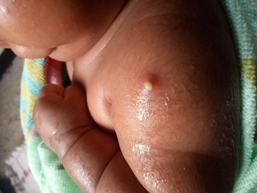 หนองออกที่ฝี