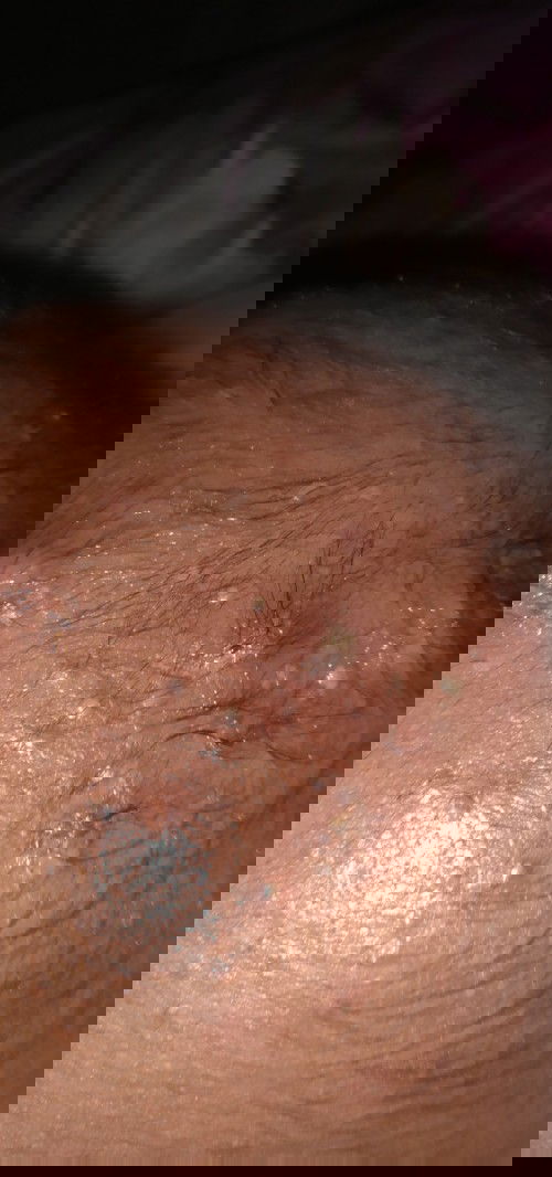 Bisul di kepala bayi