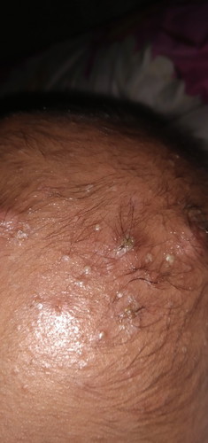 Bisul di kepala bayi