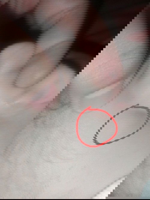 Benjolan dibelakang telinga bayi 10 bulan