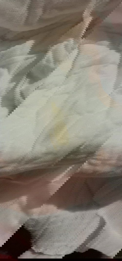 normal po ba ito? Now lng po ito,change diaper sna kay bby kc puni na then nakita ko to parang nana